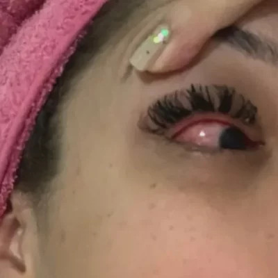 Pacientes buscam emergência após uso de pomada capilar