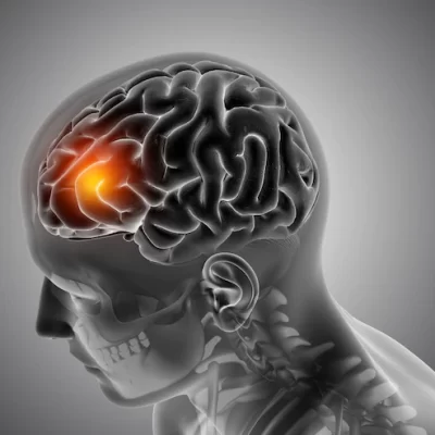 Inteligência artificial prevê a genética de tumores cerebrais cancerígenos em menos de 90 segundos