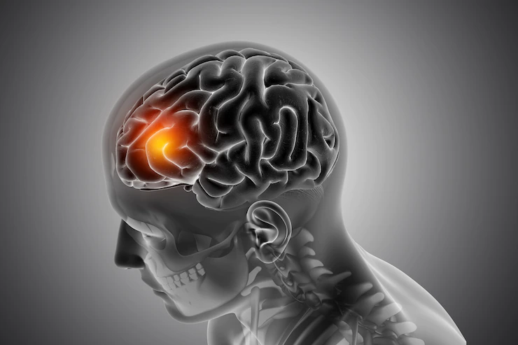 Inteligência artificial prevê a genética de tumores cerebrais cancerígenos em menos de 90 segundos