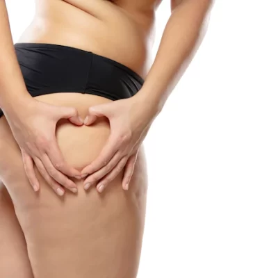 Lipedema: uma doença que afeta milhões de mulheres e pode ser confundida com obesidade