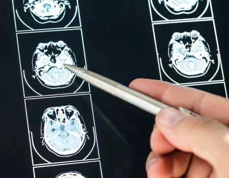 Variante genética protege contra Alzheimer, aponta estudo