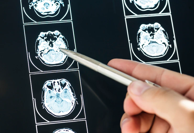 Novo medicamento promete retardar Alzheimer em 35%, diz estudo