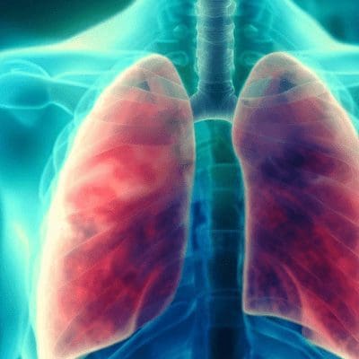 RSV: o vírus respiratório grave que muitos desconhecem