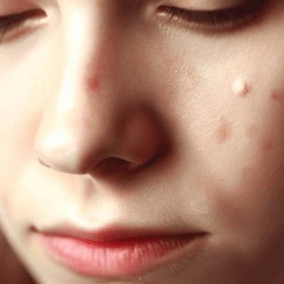 Acne pode matar? Saiba como prevenir e tratar a doença de pele