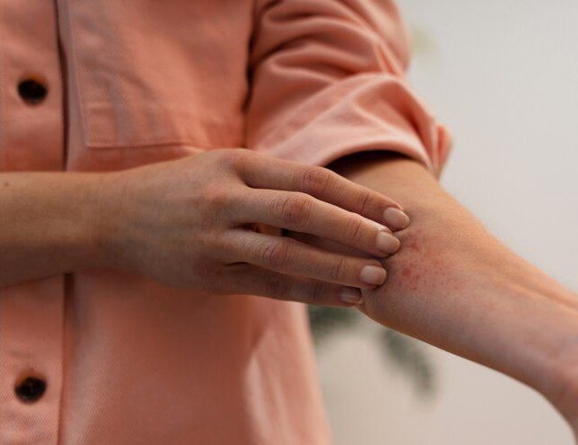 Psoríase: uma doença da pele que afeta milhões de pessoas