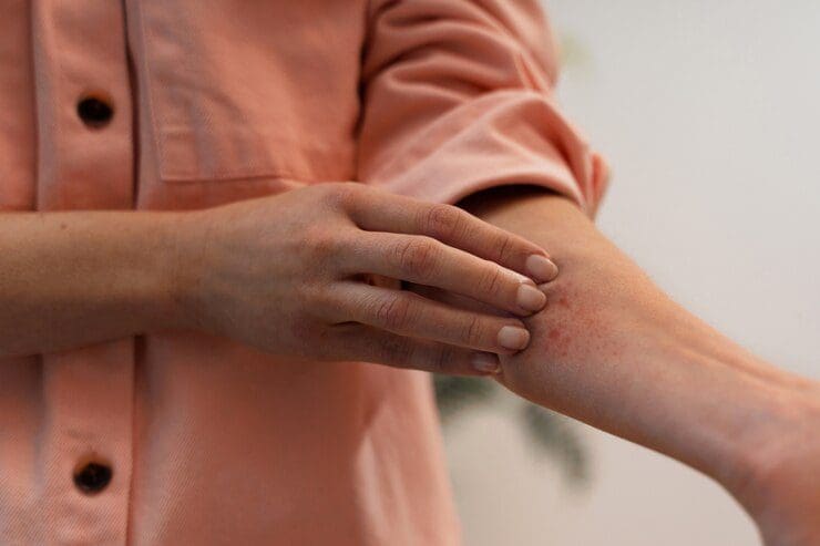 Psoríase: uma doença da pele que afeta milhões de pessoas