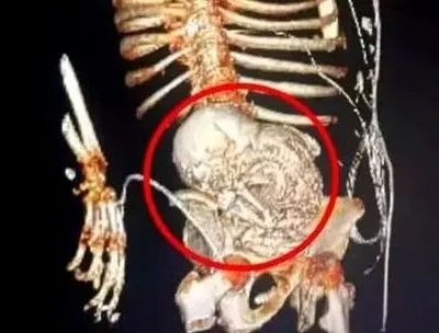 Mulher de 81 Anos carrega feto calcificado por décadas